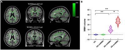 Correspondence between white matter hyperintensities and regional grey matter volumes in Alzheimer's disease